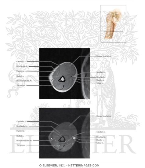 Upper Arm Axial 7