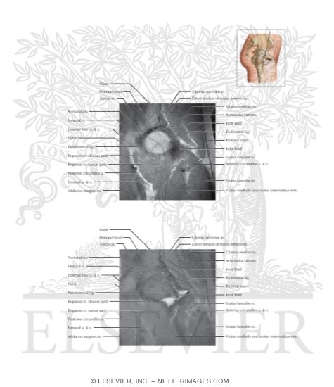 Hip Coronal Oblique 6