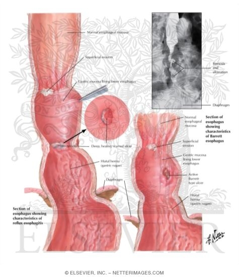 Gastric Peptic Ulcer in Gastric-Lined Esophagus