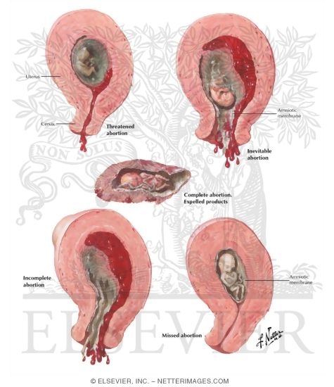 Abortion