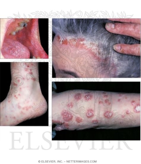 Lichen Planus and Psoriasis