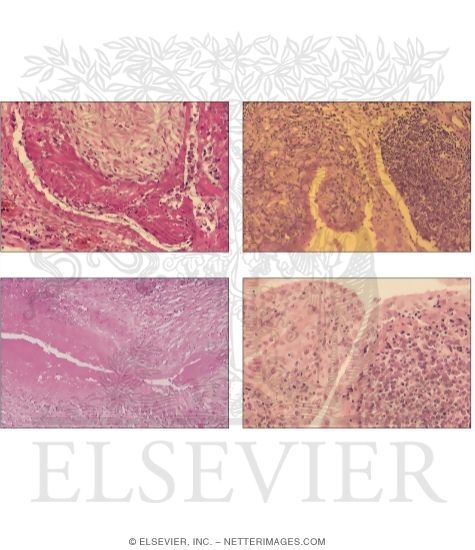 COLLAGEN VASCULAR DISEASE collagen vascular disease:
