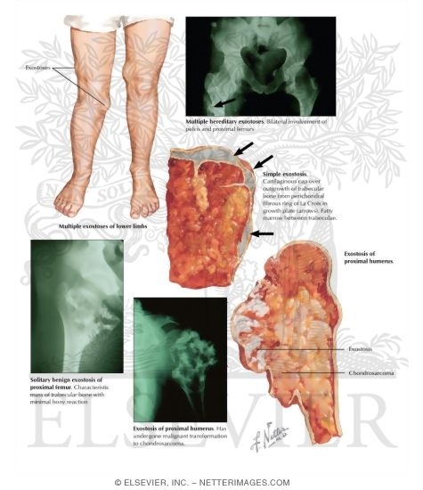 Osteocartilaginous Exostosis (Osteochondroma)