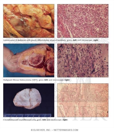Malignant Soft Tissue Tumors