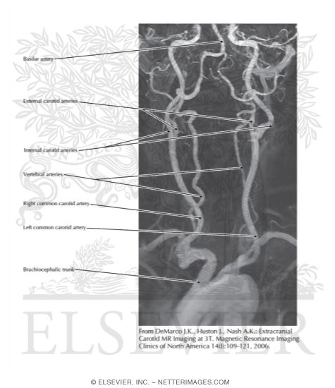 CE MRA of the Arteries Supplying the Brain