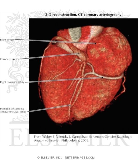 3-D Reconstruciton, CT Coronary Arteriography