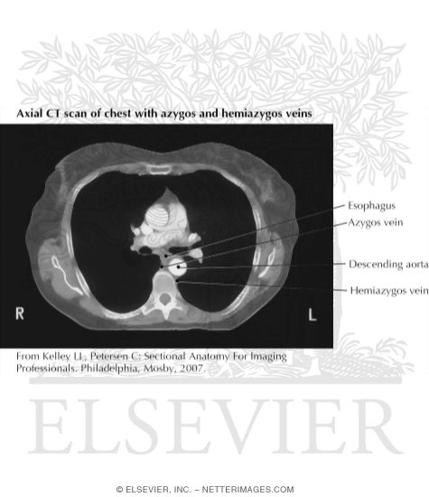 ct scan thickened esophagus