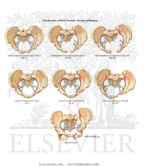 Classification of Pelvic Fractures (Young and Burgess) Trauma
