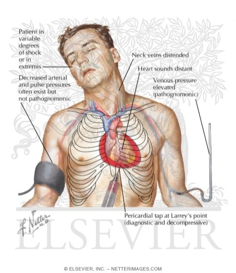 Cardiac Tamponade and Pericardiocentesis