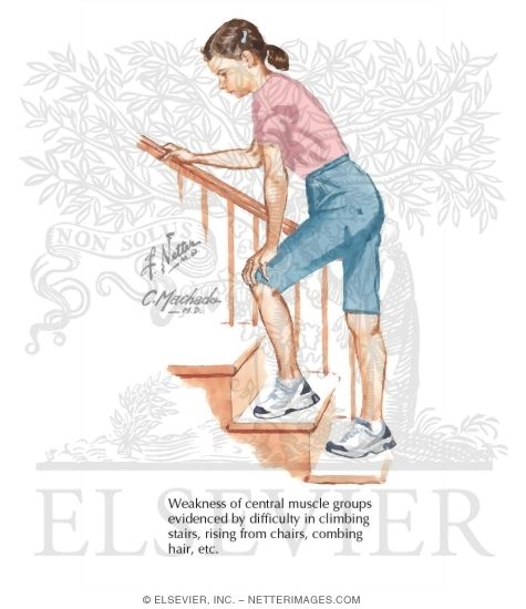 Proximal Muscle Weakness In Juvenile Dermatomyositis proximal-muscle-weakness-in-juvenile-dermatomyositis