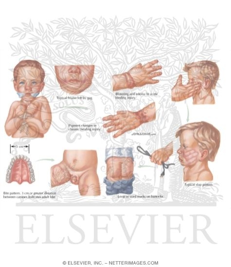 Child Abuse Injury Patterns