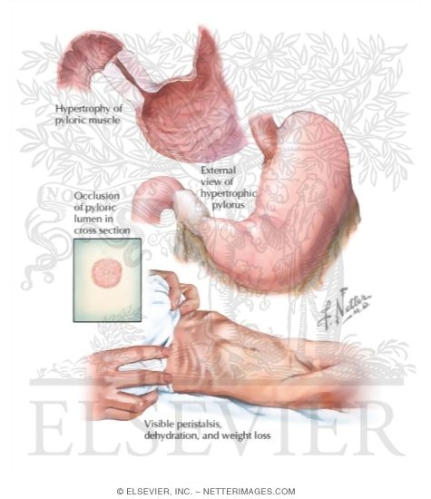 Hypertrophic Pyloric Stenosis