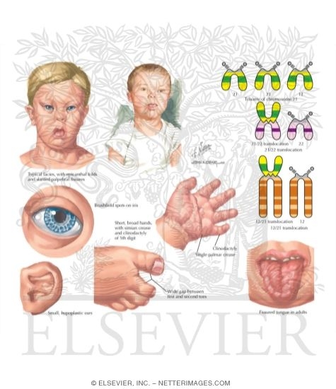 Trisomy 21 (Down Syndrome)