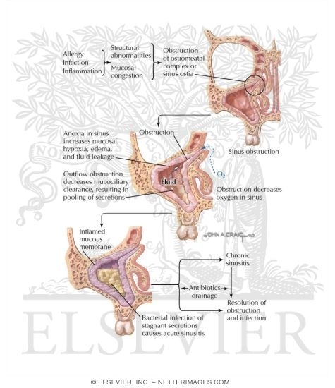 Pathogenesis of Sinusitis