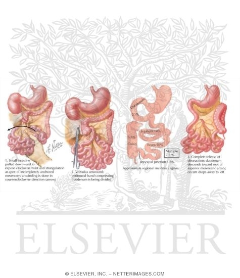 Watermarked preview of labeled image: Congenital Intestinal Abnormalities, Including Malrotation of the Colon With Volvulus of the Midgut