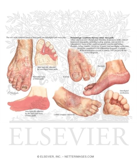 Diagnosis of Tinea Pedis