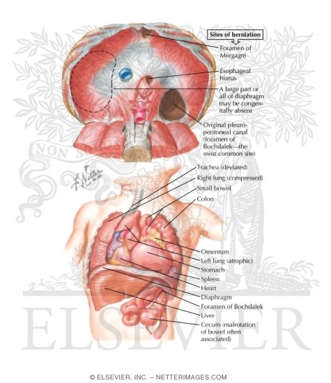 Congenital Diaphragmatic Hernia