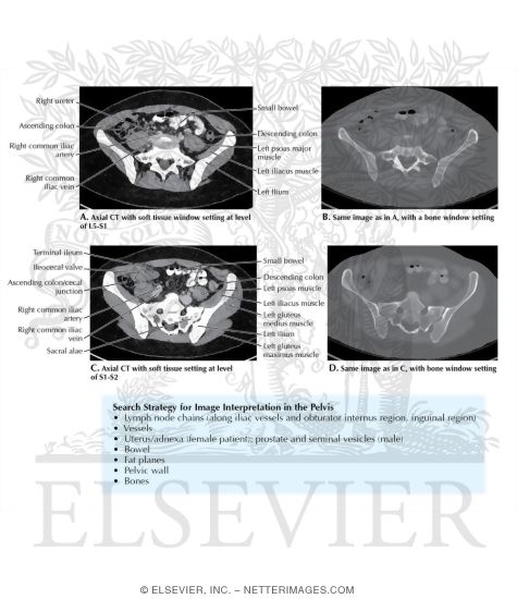 Image Search Strategy in the Upper Female Pelvis