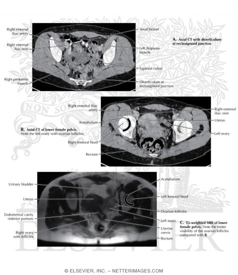 Image Search Strategy in the Lower Female Pelvis