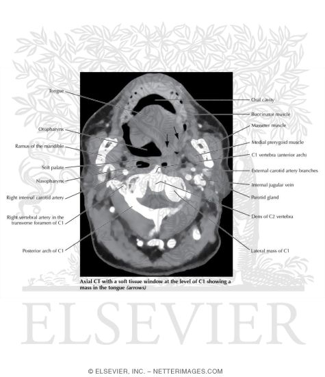 Imaging Pathology of the Oral Cavity. 