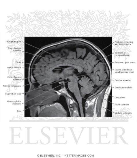 Midsagittal T1 MRI 