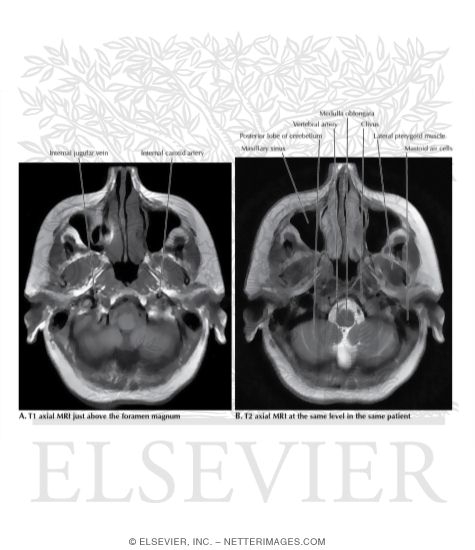 T1 and T2 Axial MRI Through the Medulla Oblongata 
