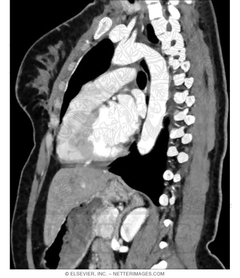 Sagittal Reconstruction of Axially Acquired CT Data Through the Left Chest