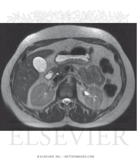 CT Vs. MRI In Abdominal Studies