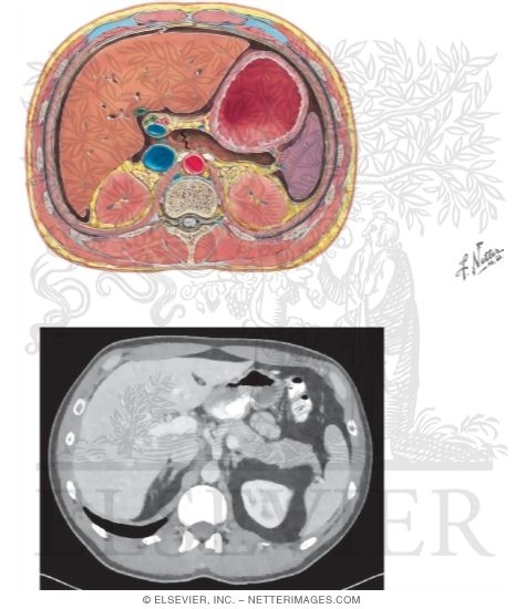 Cross Section at T12 With CT