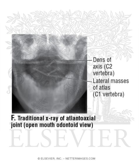 Traditional X-Ray of Atlantoaxial Joint (Open Mouth Odontoid View)