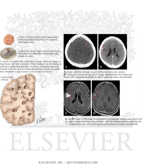 Cysticerosis