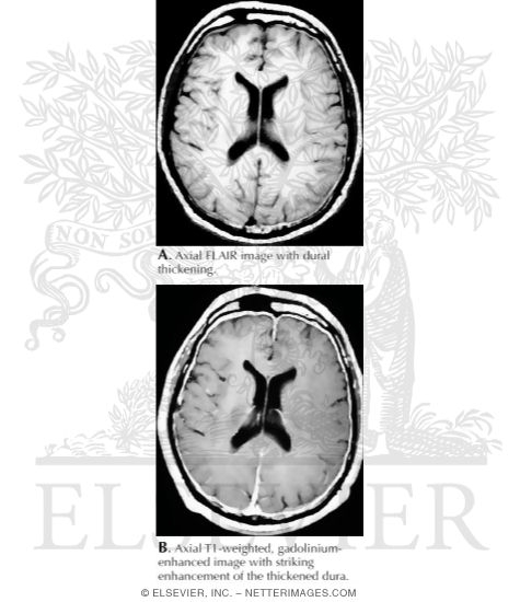Intracranial Hypotension
