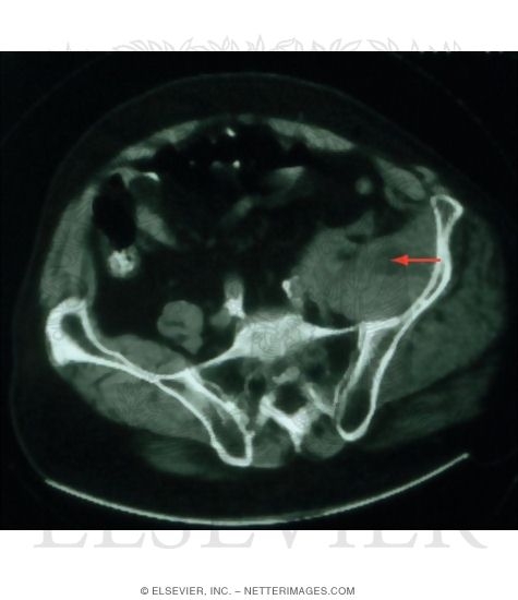 Large Hematoma