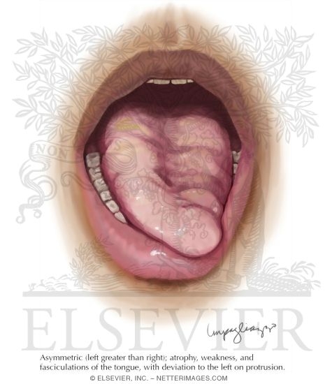 Tongue Atrophy In Amyotrophic Lateral Sclerosis