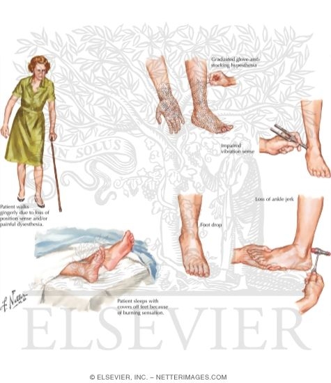 Peripheral Neuropathies: Clinical Manifestations