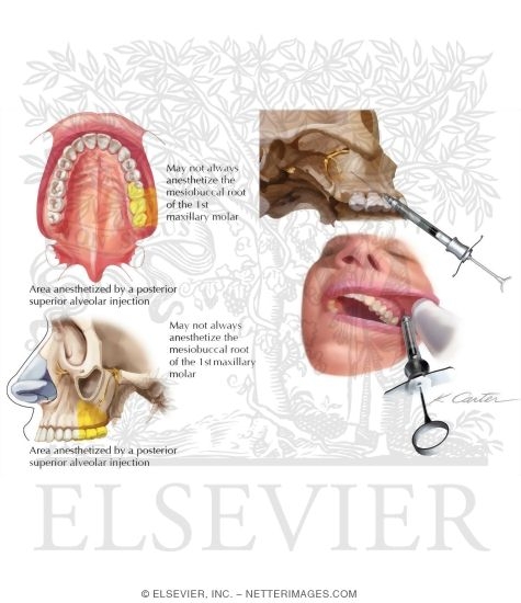 Maxillary Injections: Posterior Superior Alveolar Nerve Block