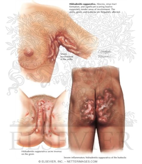 Hidradenitis Suppurativa (Acne Inversa)