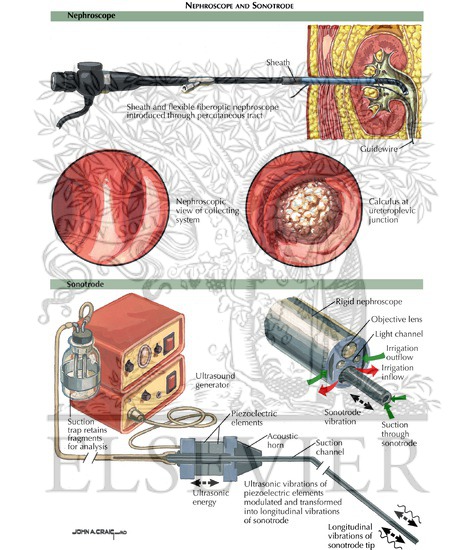 Percutaneous Nephrolithotomy: Nephroscope and Sonotrode