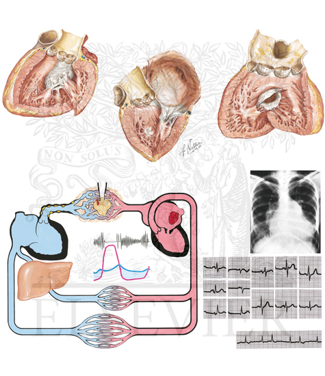 Pathophysiology and Clinical Aspects of Mitral Stenosis