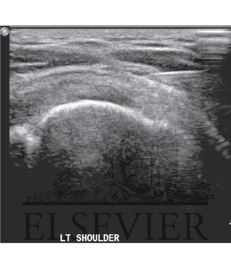 An ultrasound-guided subacromial/subdeltoid bursal injection is demonstrated with placement of the needle tip (the bright linear structure at the upper right of the image) between the deltoid muscle and rotator cuff