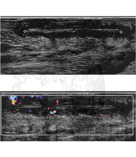 Long-axis image of a foreign body in the plantar foot