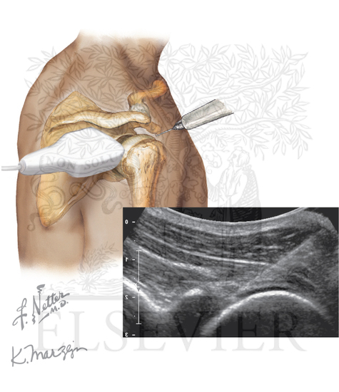 Glenohumeral joint injection: posterior approach