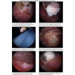 Techniques for Introduction of Chest Drainage Tubes