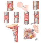 Tracheal Resection and Anastomosis