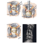 Anterior Interbody Fusion by Dowel Graft