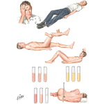 Clinical Manifestations of Congenital Aneurysm Rupture