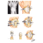 Implant Resection Arthroplasty for Distal Radioulnar Joint