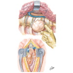 Removal of Mediastinal Tumors