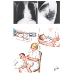 Cystic Fibrosis: Aspects of Diagnosis and Management