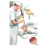 Bronchofiberscopic Suction and Lavage